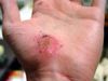 Hand Abrasion - 2 days 22 hours 12 minutes after injury.jpg