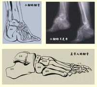 Foot X-Rays